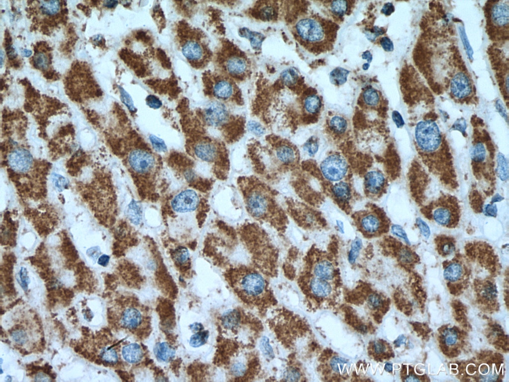 Immunohistochemistry (IHC) staining of human liver cancer tissue using UQCRC2 Monoclonal antibody (67547-1-Ig)