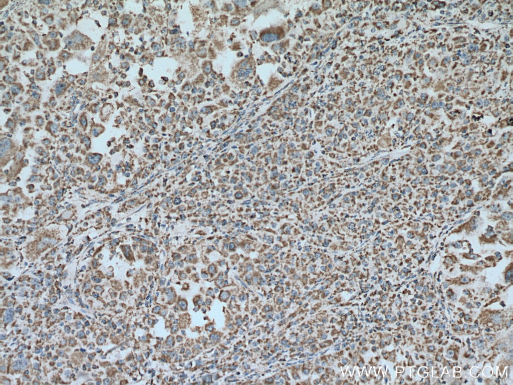 IHC staining of human liver cancer using 67547-1-Ig