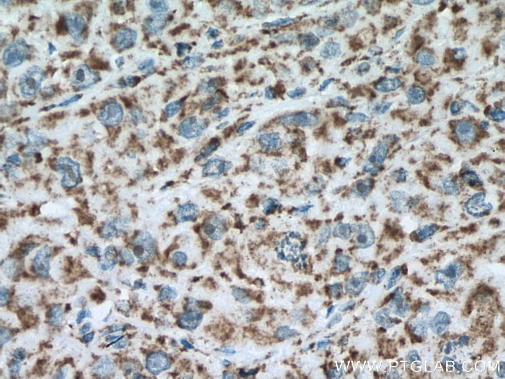 IHC staining of human liver cancer using 67547-1-Ig