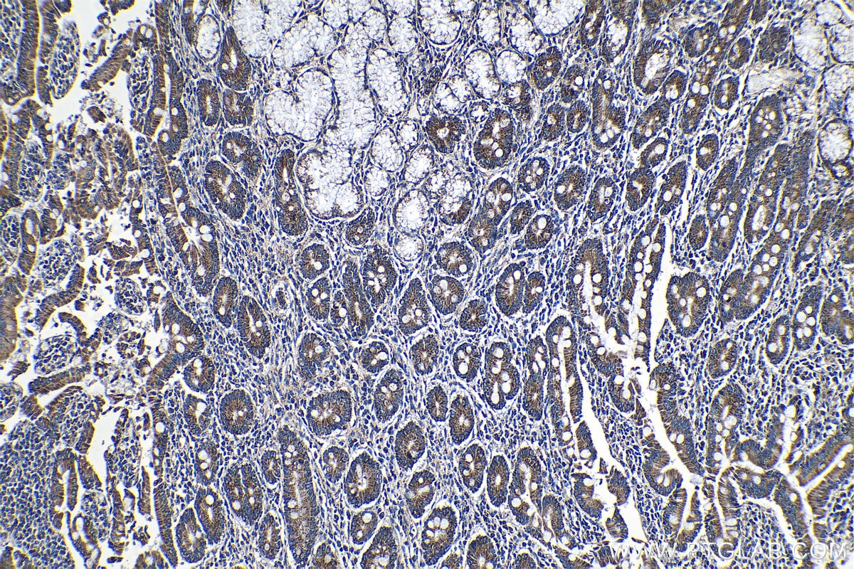 Immunohistochemistry (IHC) staining of human stomach cancer tissue using UQCRFS1 Polyclonal antibody (18443-1-AP)