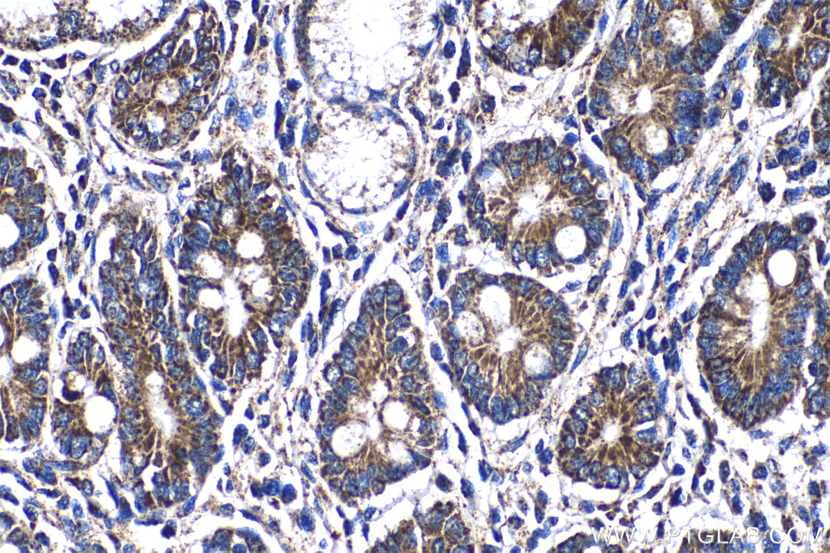 Immunohistochemistry (IHC) staining of human stomach cancer tissue using UQCRFS1 Polyclonal antibody (18443-1-AP)