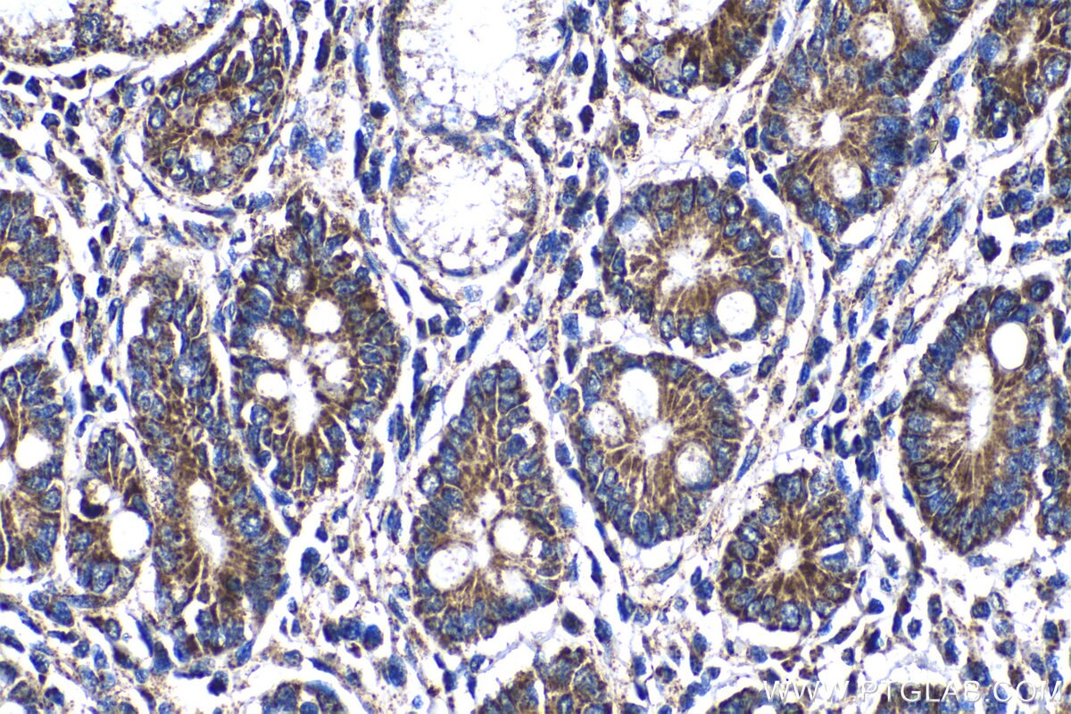 IHC staining of human stomach cancer using 18443-1-AP