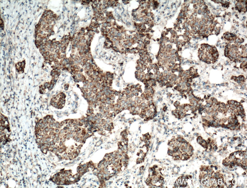 IHC staining of human breast cancer using 12364-1-AP