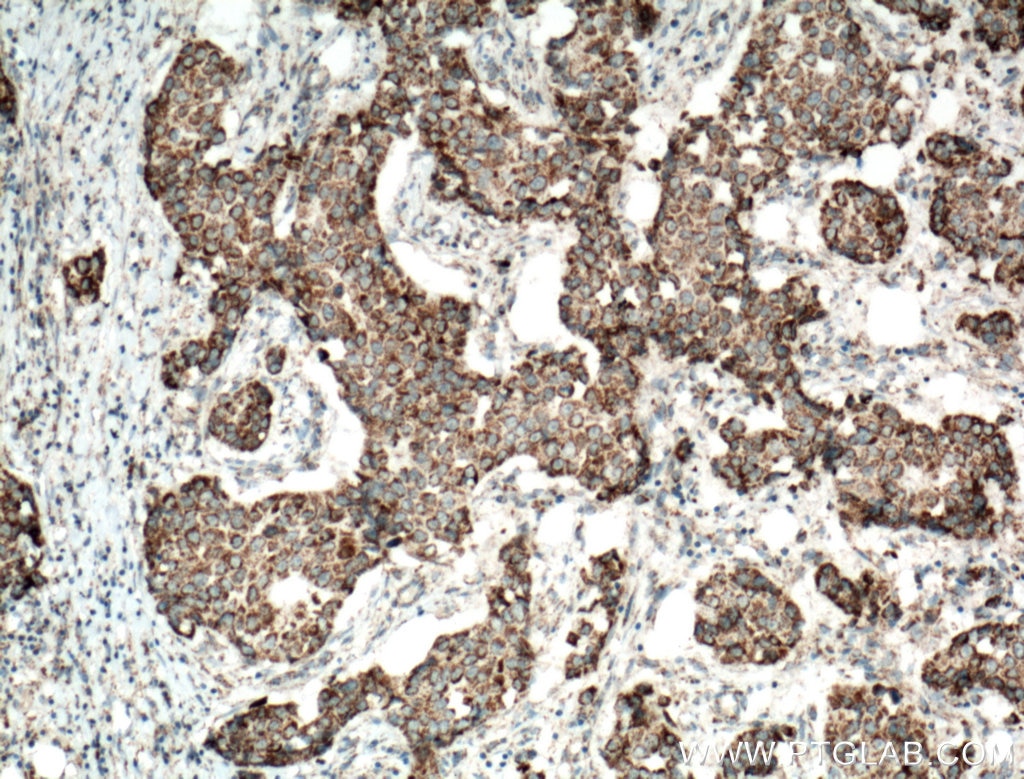 Immunohistochemistry (IHC) staining of human breast cancer tissue using UQCRH Polyclonal antibody (12364-1-AP)