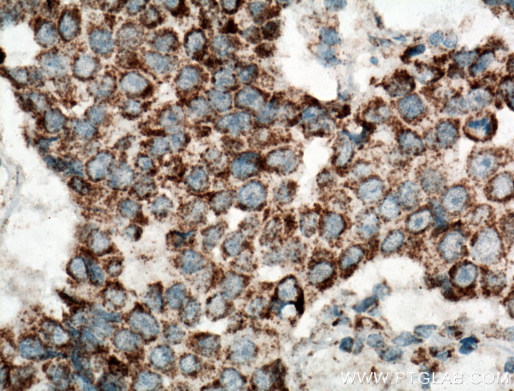 Immunohistochemistry (IHC) staining of human breast cancer tissue using UQCRH Polyclonal antibody (12364-1-AP)