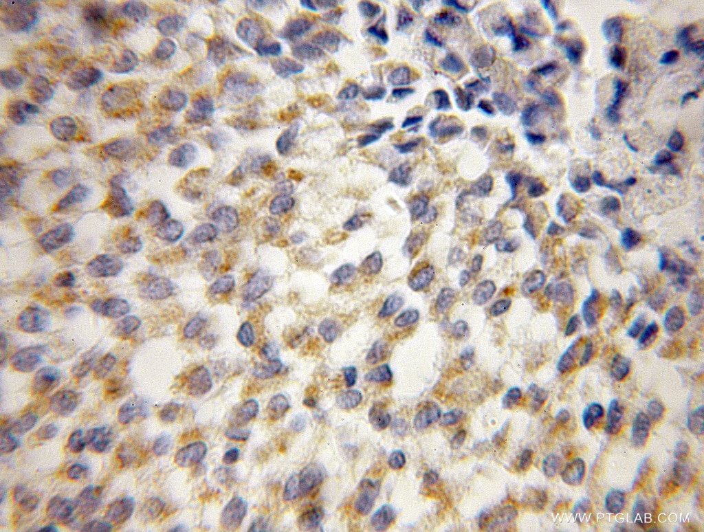Immunohistochemistry (IHC) staining of human breast cancer tissue using UQCRH Polyclonal antibody (12364-1-AP)