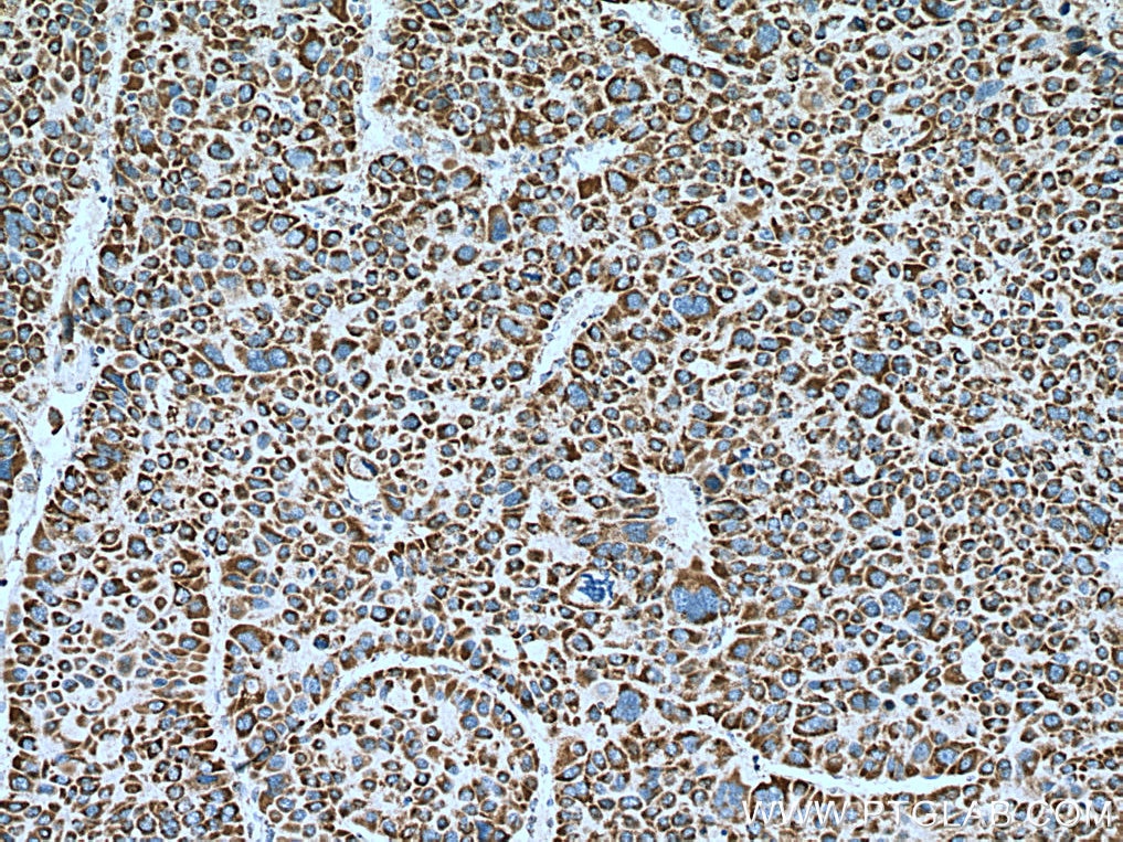 Immunohistochemistry (IHC) staining of human liver cancer tissue using UQCRQ Polyclonal antibody (14975-1-AP)