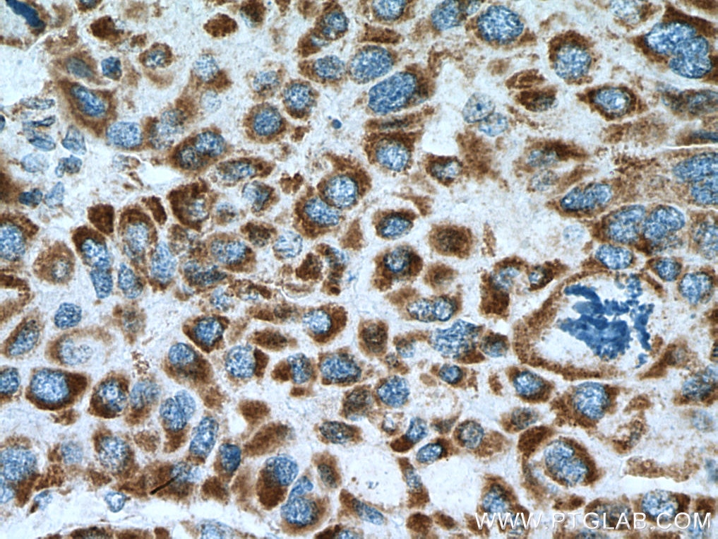 Immunohistochemistry (IHC) staining of human liver cancer tissue using UQCRQ Polyclonal antibody (14975-1-AP)