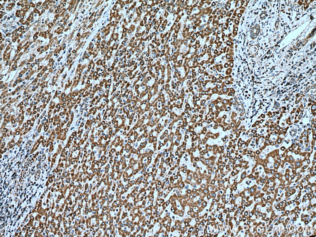 Immunohistochemistry (IHC) staining of human liver cancer tissue using UQCRQ Polyclonal antibody (14975-1-AP)