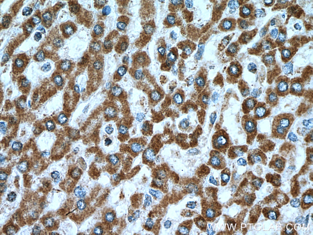 Immunohistochemistry (IHC) staining of human liver cancer tissue using UQCRQ Polyclonal antibody (14975-1-AP)