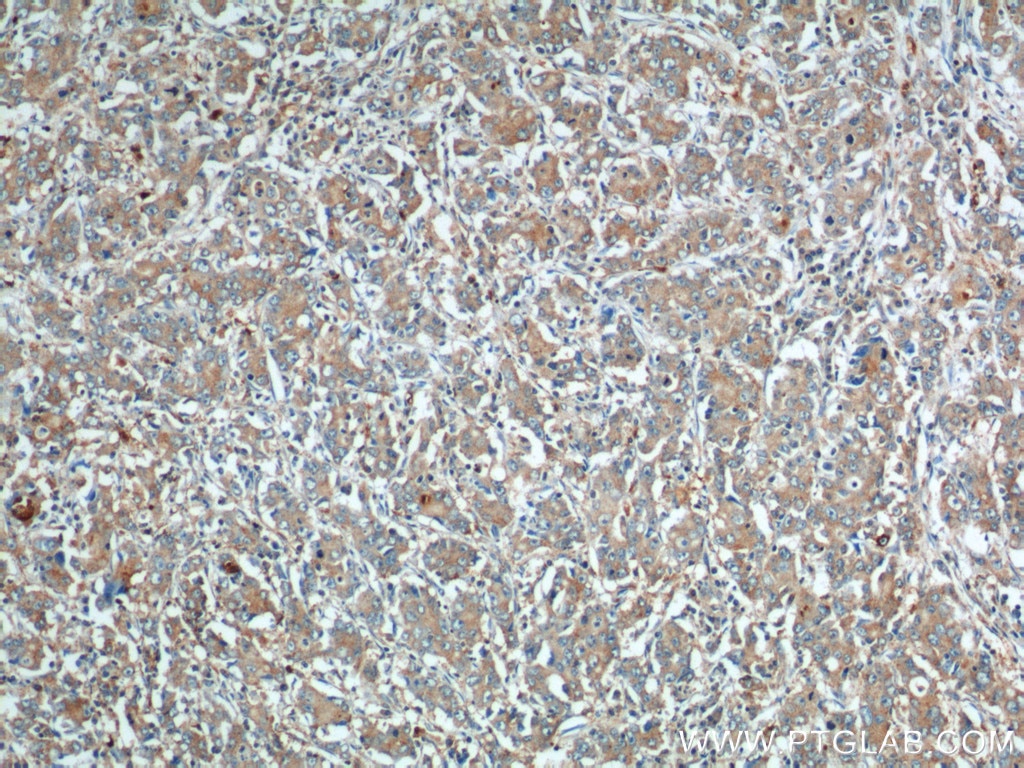 Immunohistochemistry (IHC) staining of human stomach cancer tissue using URG4 Polyclonal antibody (11998-1-AP)
