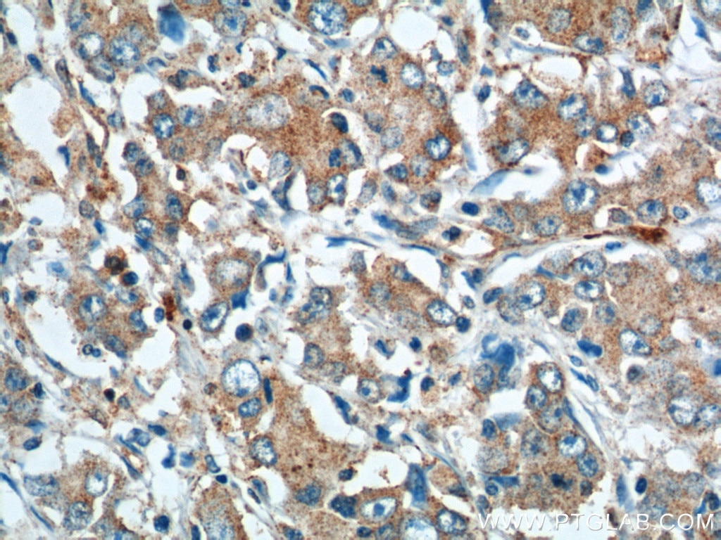Immunohistochemistry (IHC) staining of human stomach cancer tissue using URG4 Polyclonal antibody (11998-1-AP)