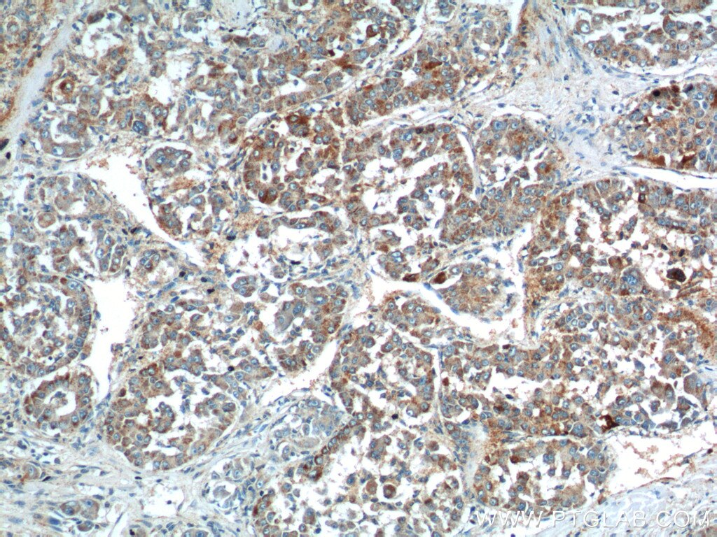Immunohistochemistry (IHC) staining of human liver cancer tissue using URG4 Polyclonal antibody (11998-1-AP)