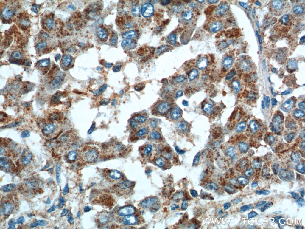 Immunohistochemistry (IHC) staining of human liver cancer tissue using URG4 Polyclonal antibody (11998-1-AP)