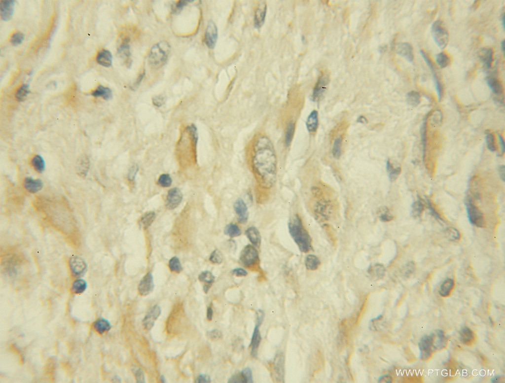 Immunohistochemistry (IHC) staining of human gliomas tissue using URG4 Polyclonal antibody (11998-1-AP)