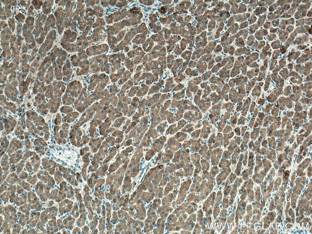 Immunohistochemistry (IHC) staining of human liver cancer tissue using URG4 Monoclonal antibody (67144-1-Ig)