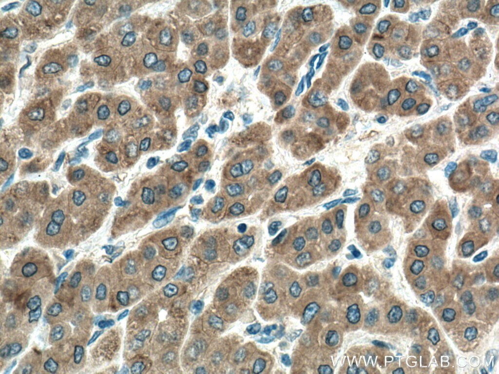 Immunohistochemistry (IHC) staining of human liver cancer tissue using URG4 Monoclonal antibody (67144-1-Ig)