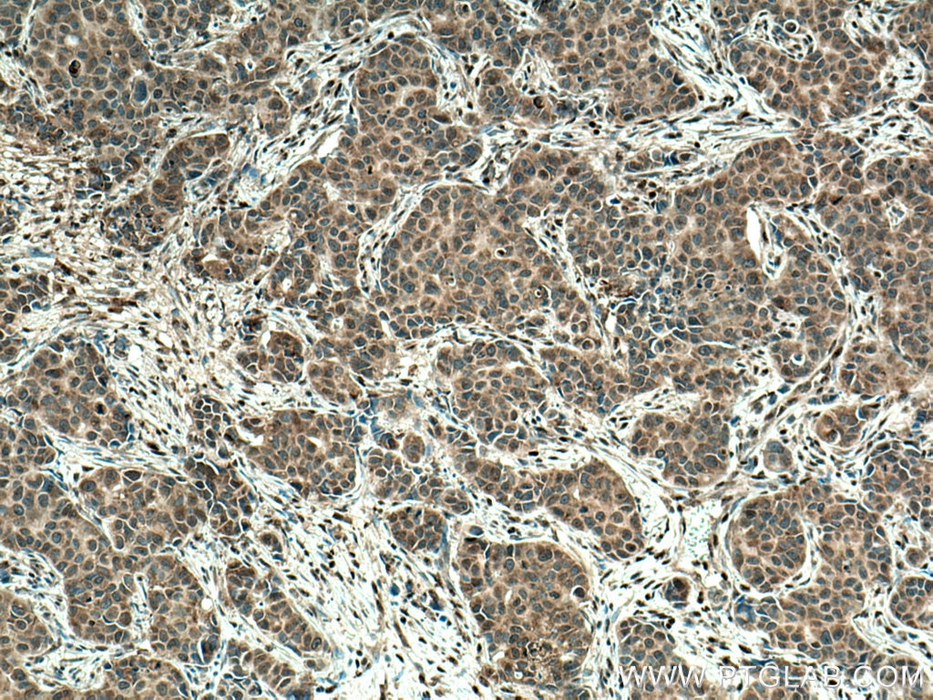 Immunohistochemistry (IHC) staining of human breast cancer tissue using URG4 Monoclonal antibody (67144-1-Ig)
