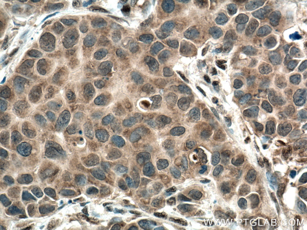 Immunohistochemistry (IHC) staining of human breast cancer tissue using URG4 Monoclonal antibody (67144-1-Ig)