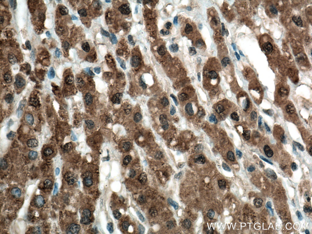 Immunohistochemistry (IHC) staining of human liver cancer tissue using URG4 Monoclonal antibody (67144-1-Ig)