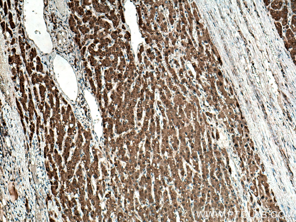 Immunohistochemistry (IHC) staining of human liver cancer tissue using URG4 Monoclonal antibody (67144-1-Ig)