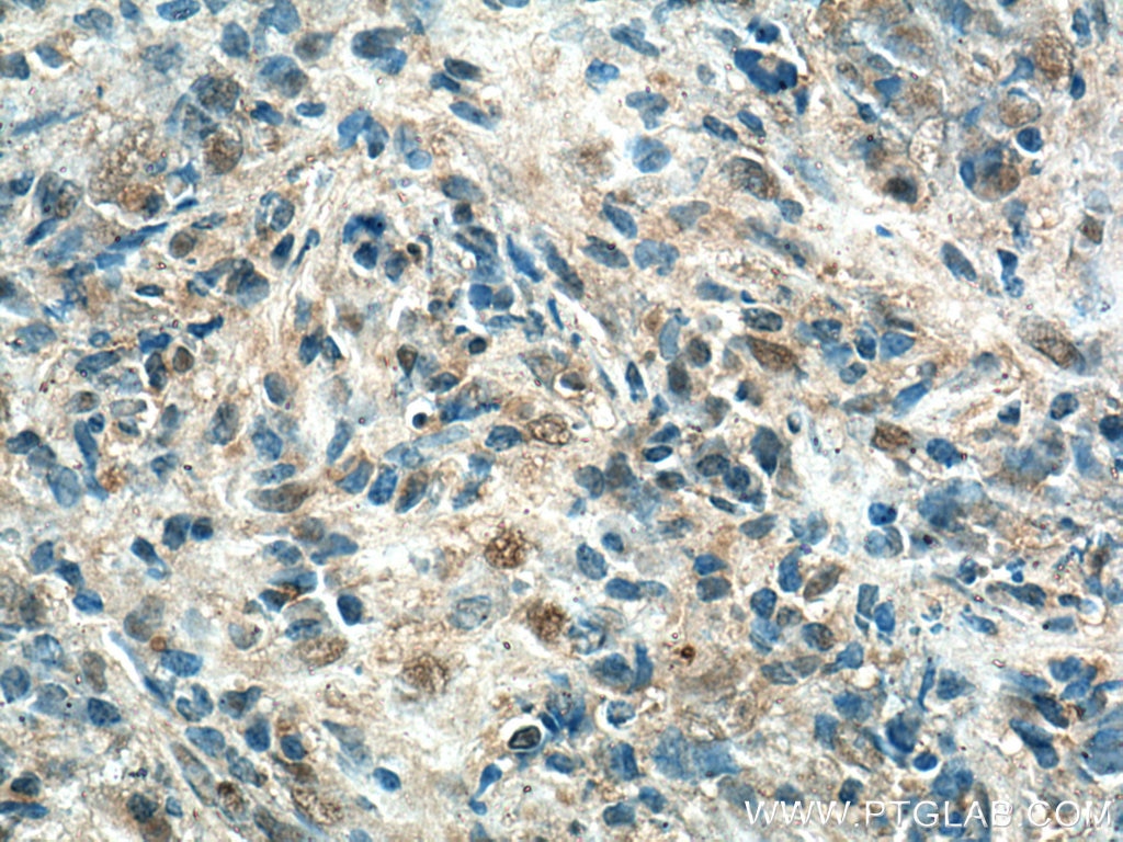 Immunohistochemistry (IHC) staining of human nasopharyngeal carcinoma tissue using URG4 Monoclonal antibody (67144-1-Ig)