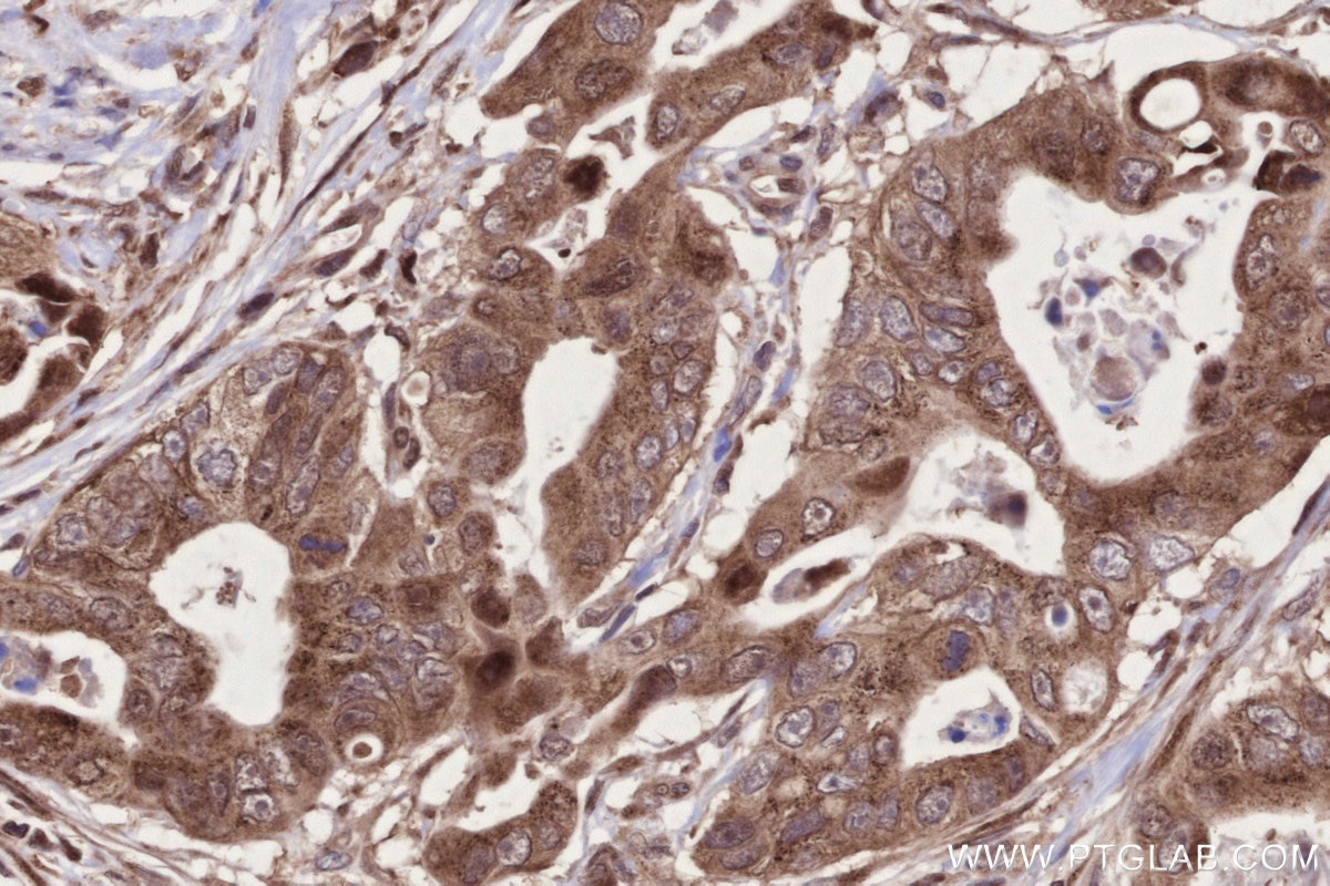 IHC staining of human stomach cancer using 67144-1-Ig Immunohistochemistry (IHC) staining of human stomach cancer tissue using URG4 Monoclonal antibody (67144-1-Ig)