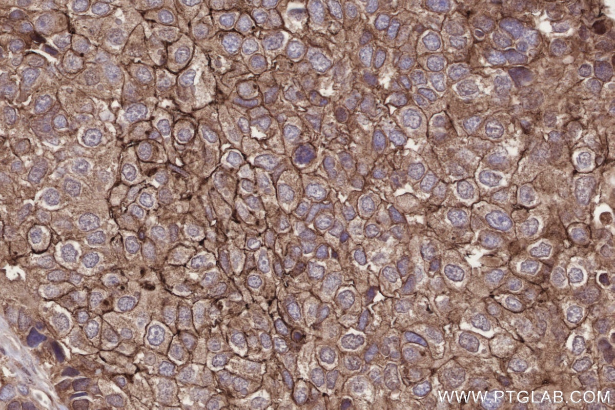 IHC staining of human stomach cancer using 67144-1-Ig Immunohistochemistry (IHC) staining of human stomach cancer tissue using URG4 Monoclonal antibody (67144-1-Ig)
