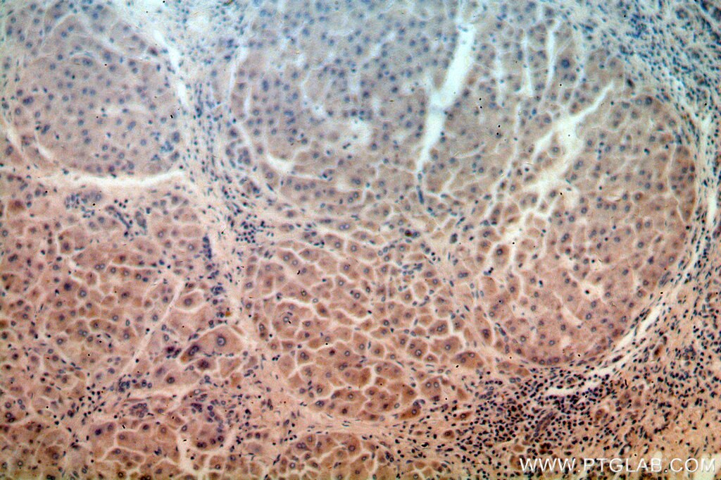 Immunohistochemistry (IHC) staining of human hepatocirrhosis tissue using URM1 Polyclonal antibody (15285-1-AP)