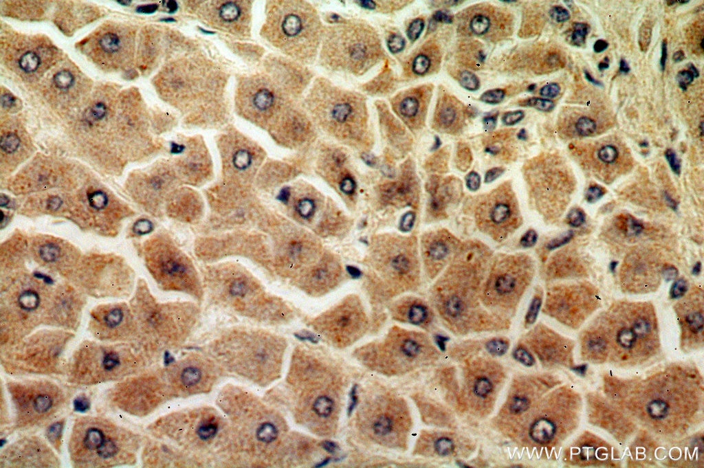 Immunohistochemistry (IHC) staining of human hepatocirrhosis tissue using URM1 Polyclonal antibody (15285-1-AP)