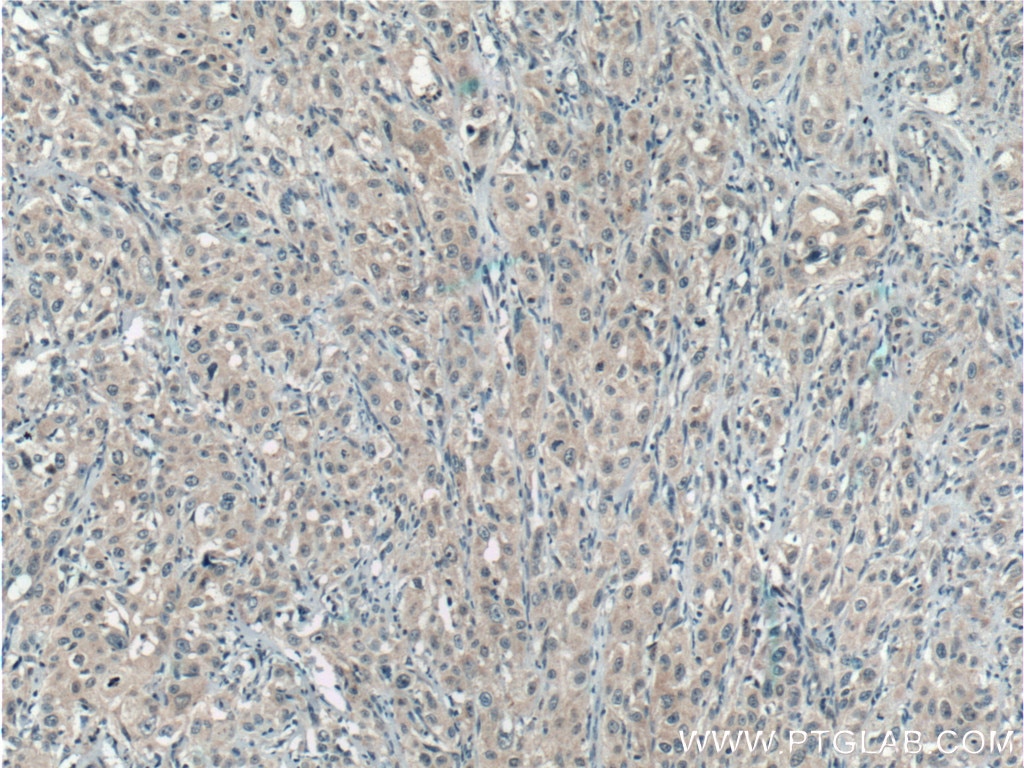 Immunohistochemistry (IHC) staining of human cervical cancer tissue using UROS Polyclonal antibody (14913-1-AP)