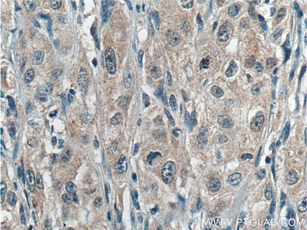 Immunohistochemistry (IHC) staining of human cervical cancer tissue using UROS Polyclonal antibody (14913-1-AP)