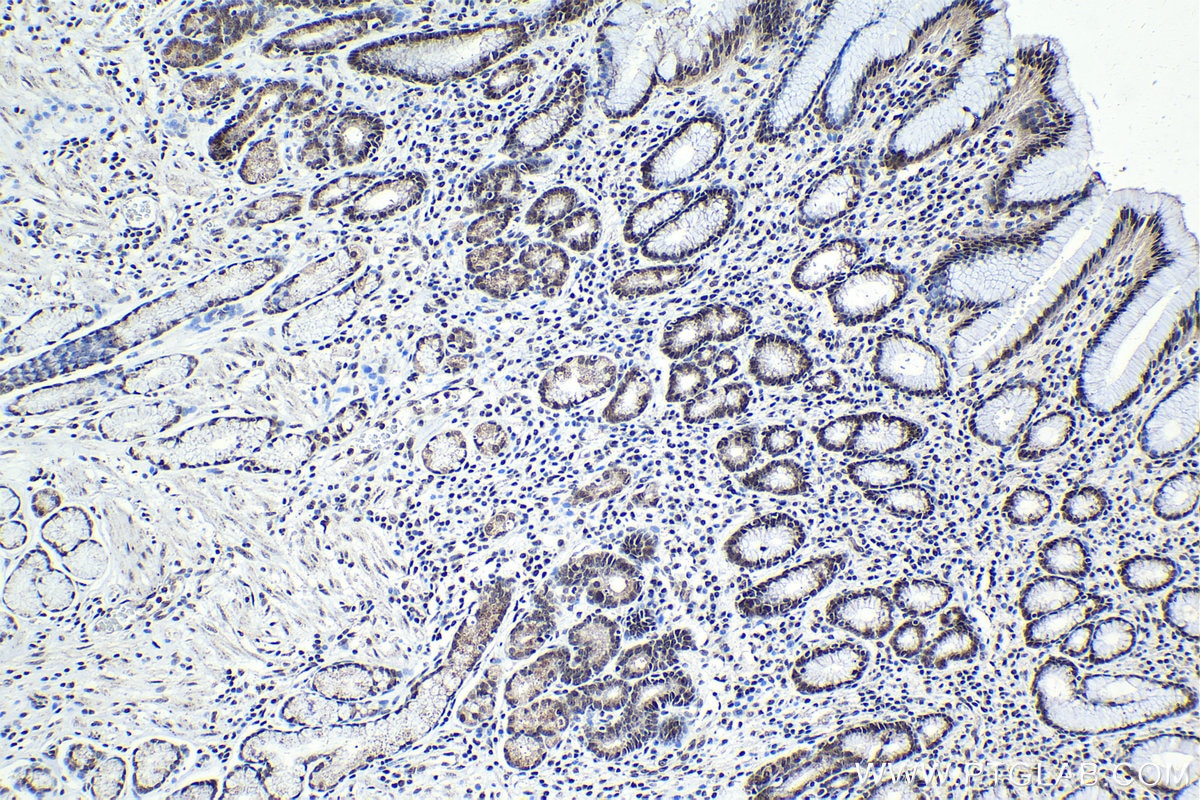 IHC staining of human stomach cancer using 22327-1-AP