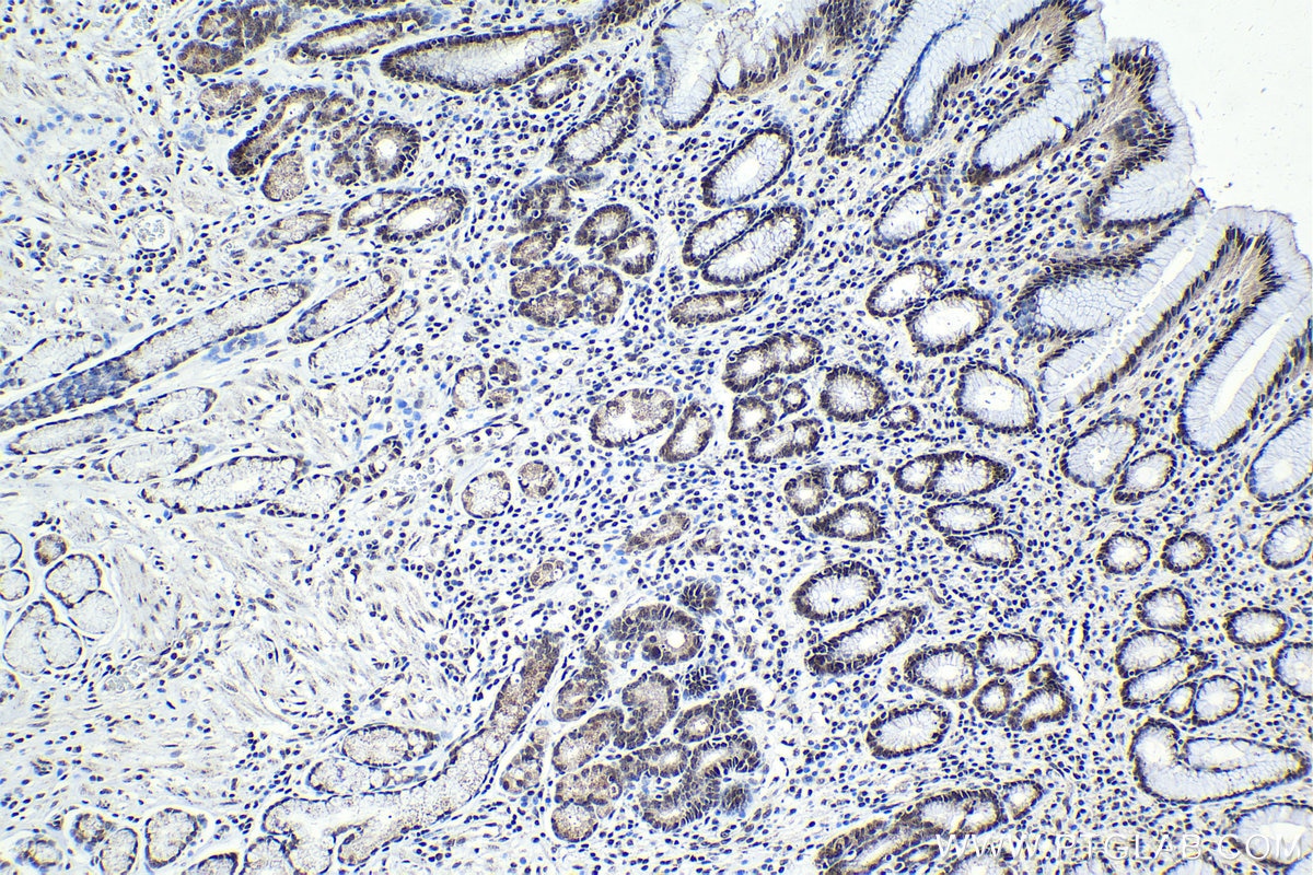 Immunohistochemistry (IHC) staining of human stomach cancer tissue using USF1 Polyclonal antibody (22327-1-AP)