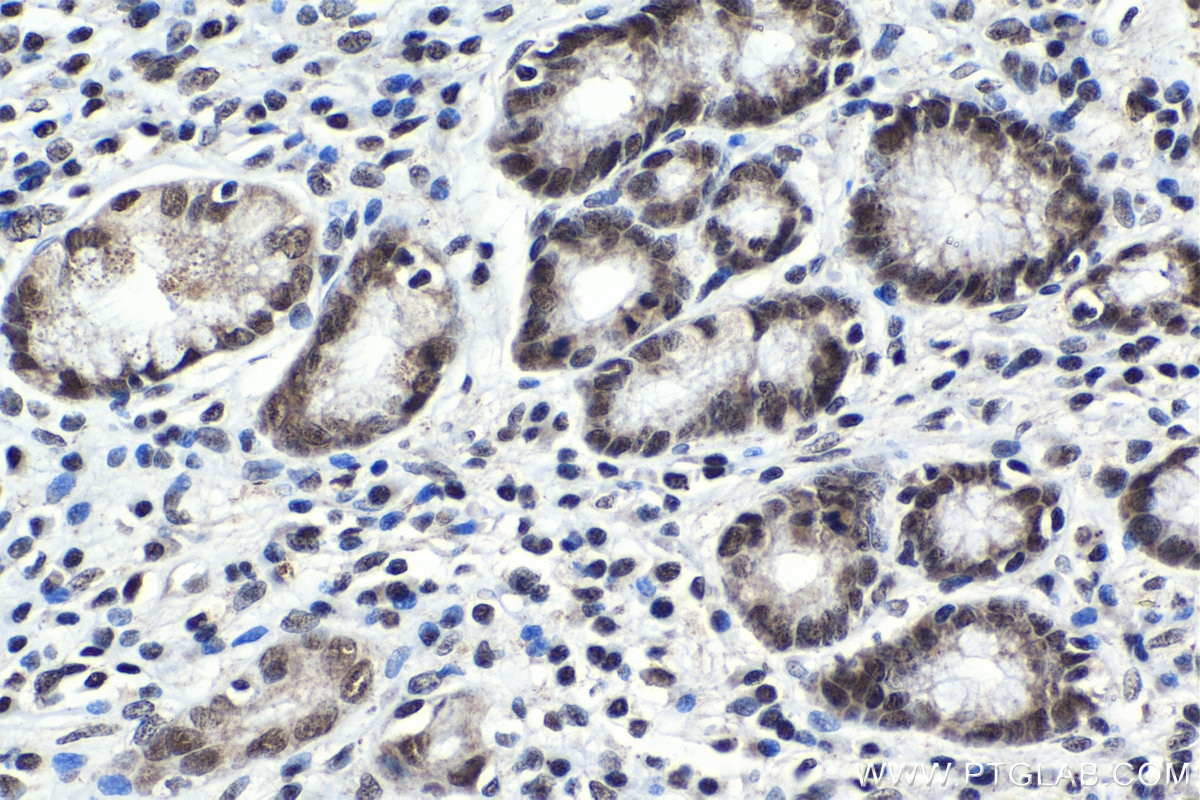 Immunohistochemistry (IHC) staining of human stomach cancer tissue using USF1 Polyclonal antibody (22327-1-AP)