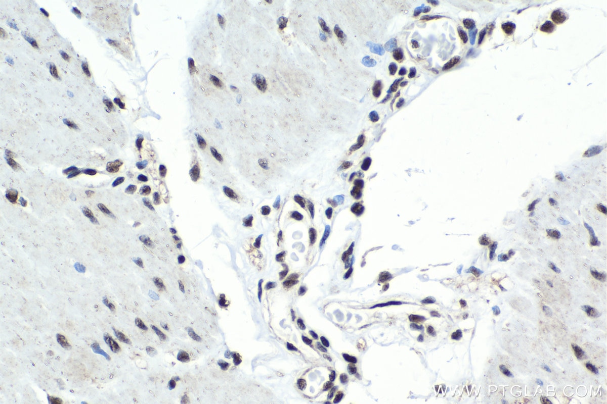 Immunohistochemistry (IHC) staining of human stomach cancer tissue using USF1 Polyclonal antibody (22327-1-AP)