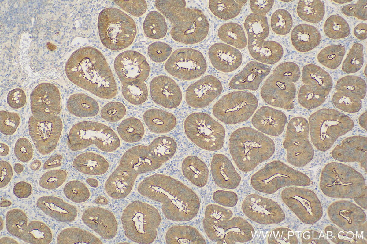 Immunohistochemistry (IHC) staining of Human Colon cancer tissue using Harmonin Polyclonal antibody (11358-1-AP)
