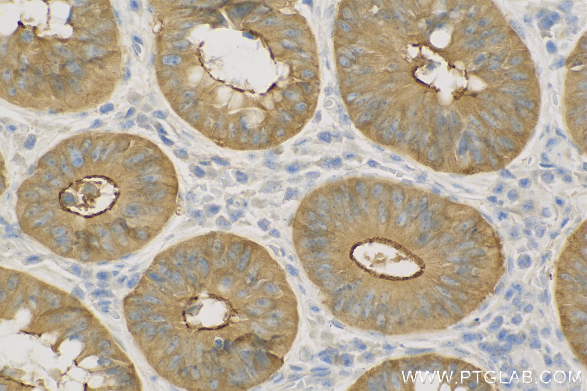 Immunohistochemistry (IHC) staining of Human Colon cancer tissue using Harmonin Polyclonal antibody (11358-1-AP)