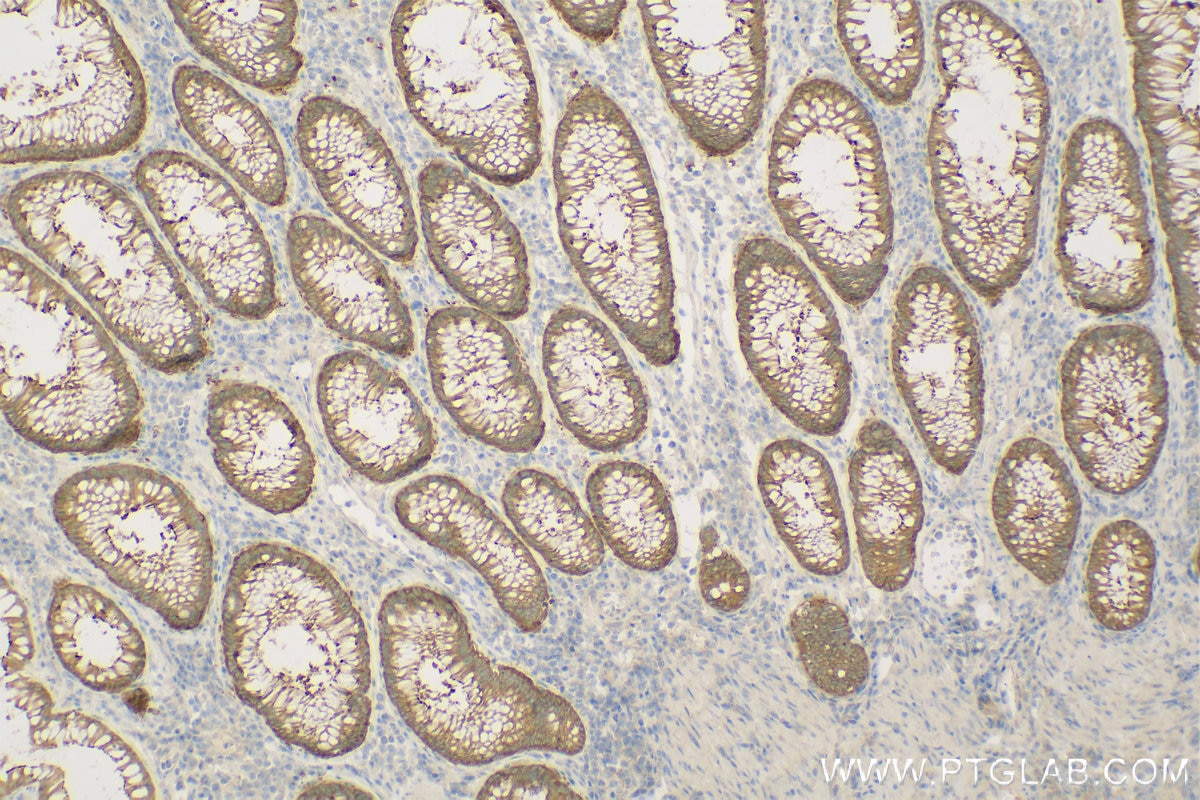 Immunohistochemistry (IHC) staining of Human Colon cancer tissue using Harmonin Polyclonal antibody (11358-1-AP)