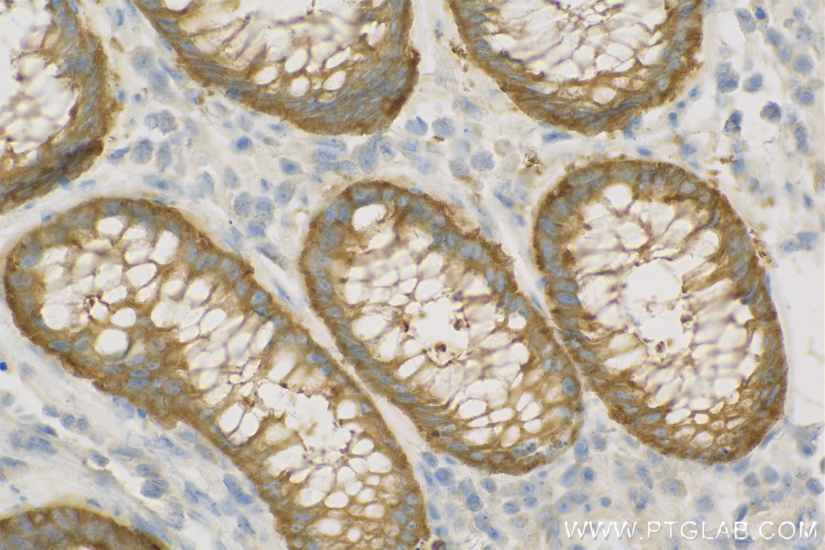 Immunohistochemistry (IHC) staining of Human Colon cancer tissue using Harmonin Polyclonal antibody (11358-1-AP)