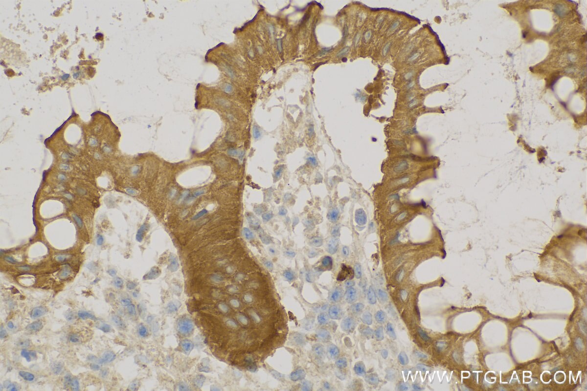 Immunohistochemistry (IHC) staining of Human Colon cancer tissue using Harmonin Polyclonal antibody (11358-1-AP)