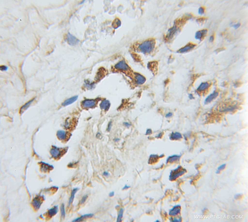 Immunohistochemistry (IHC) staining of human prostate cancer tissue using Harmonin Polyclonal antibody (11358-1-AP)