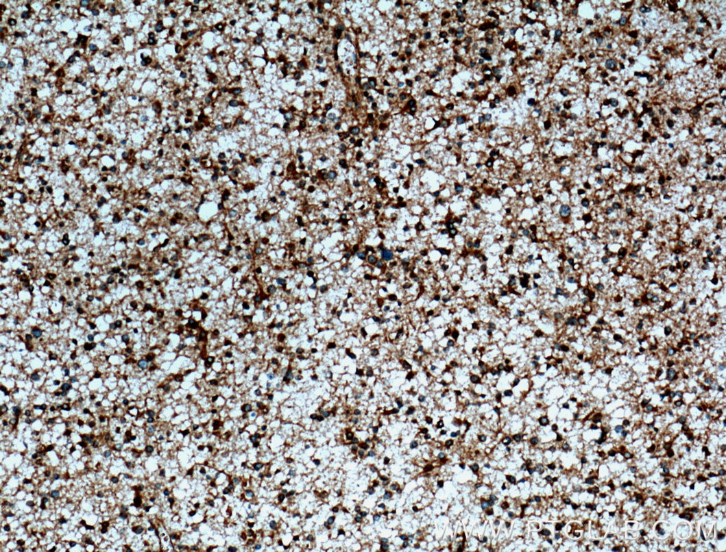 IHC staining of human gliomas using 13509-1-AP