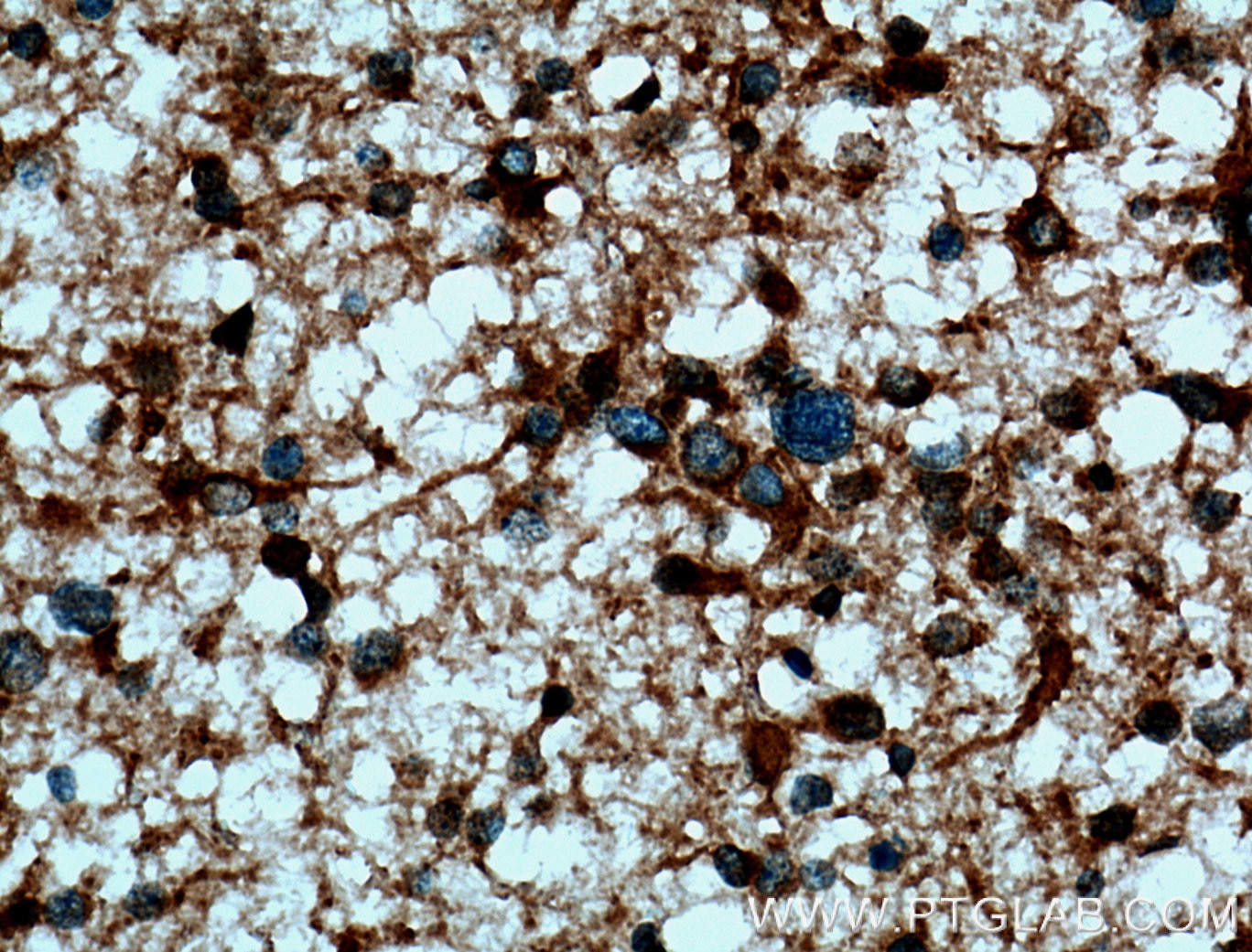 Immunohistochemistry (IHC) staining of human gliomas tissue using p115, USO1 Polyclonal antibody (13509-1-AP)