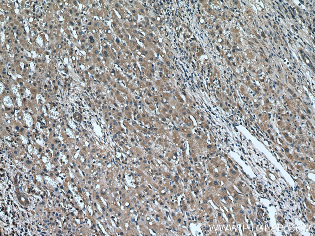 Immunohistochemistry (IHC) staining of human liver cancer tissue using USP1 Polyclonal antibody (14346-1-AP)