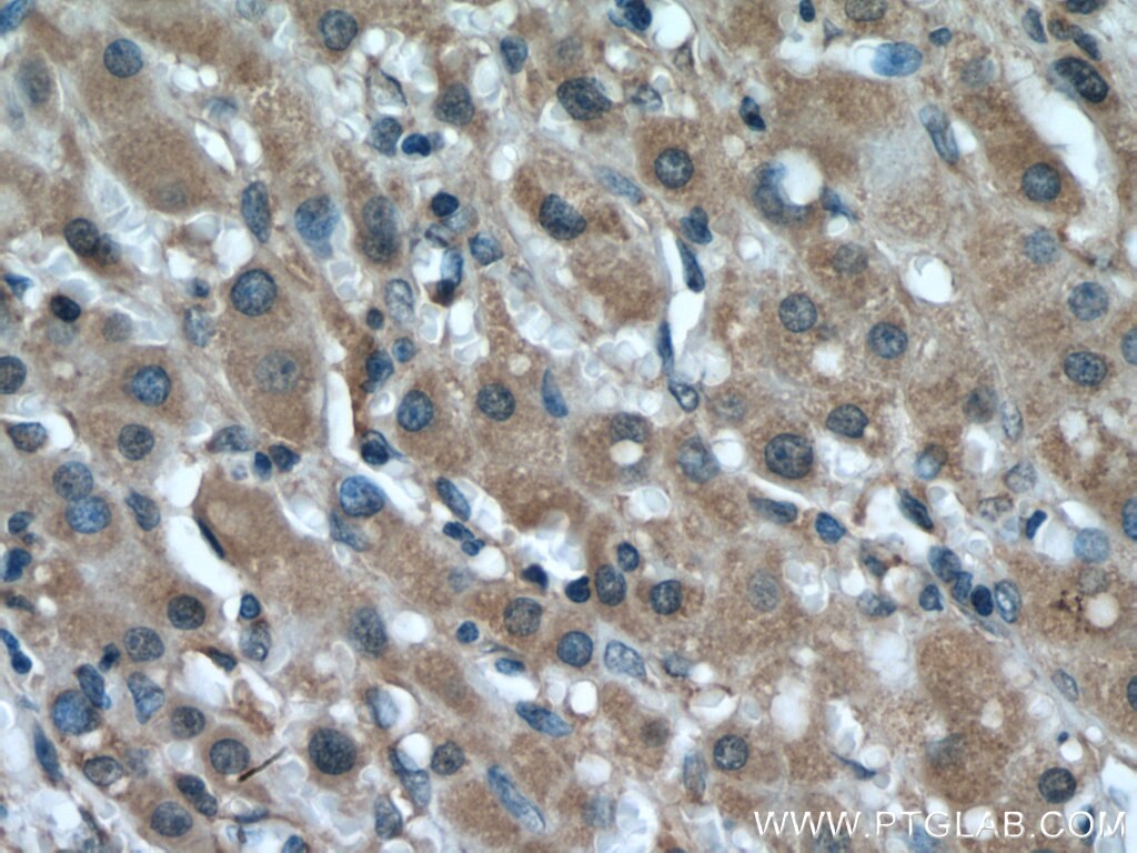 Immunohistochemistry (IHC) staining of human liver cancer tissue using USP1 Polyclonal antibody (14346-1-AP)