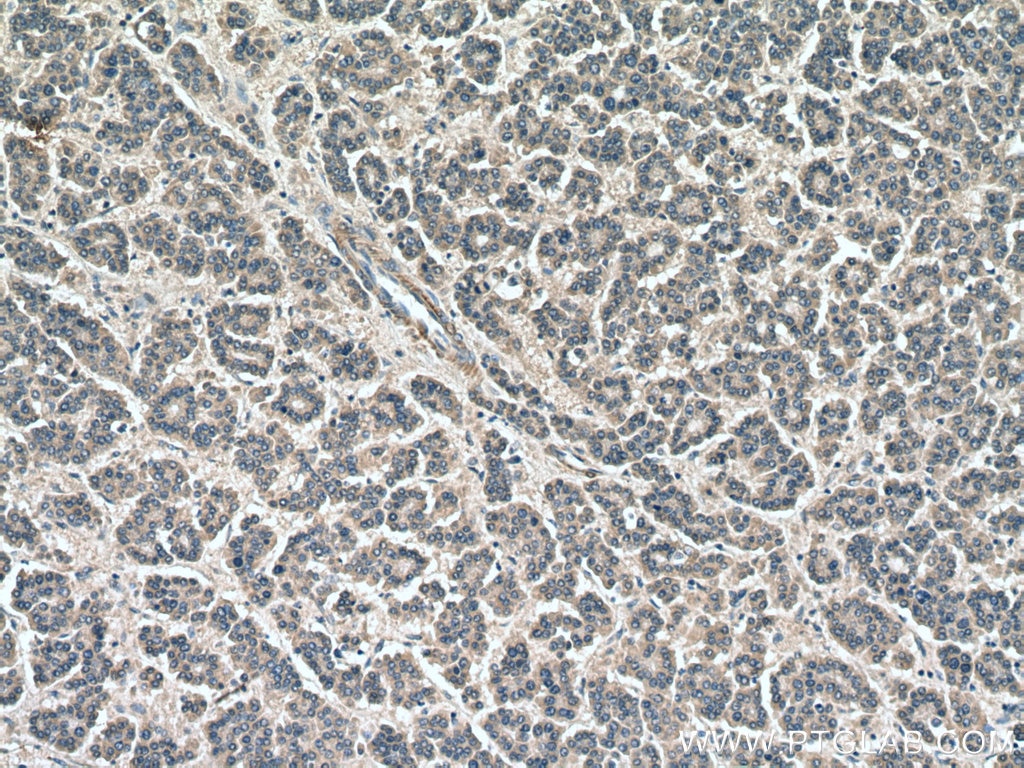 Immunohistochemistry (IHC) staining of human liver cancer tissue using USP1 Polyclonal antibody (14346-1-AP)