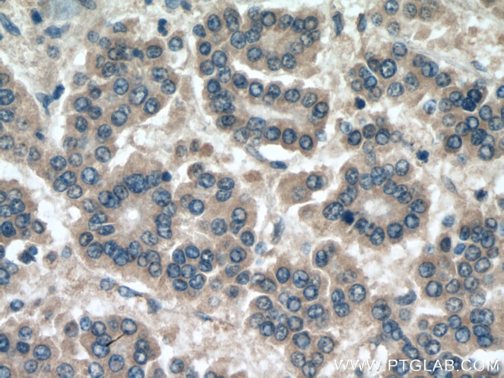 Immunohistochemistry (IHC) staining of human liver cancer tissue using USP1 Polyclonal antibody (14346-1-AP)