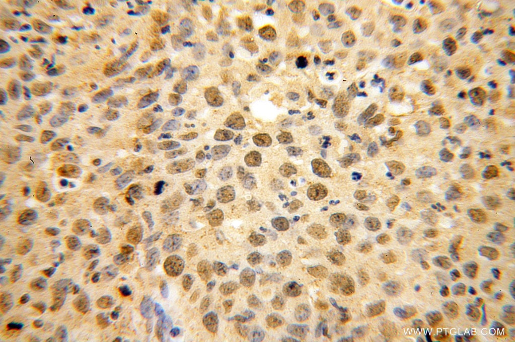 Immunohistochemistry (IHC) staining of human cervical cancer tissue using USP1 Polyclonal antibody (14346-1-AP)