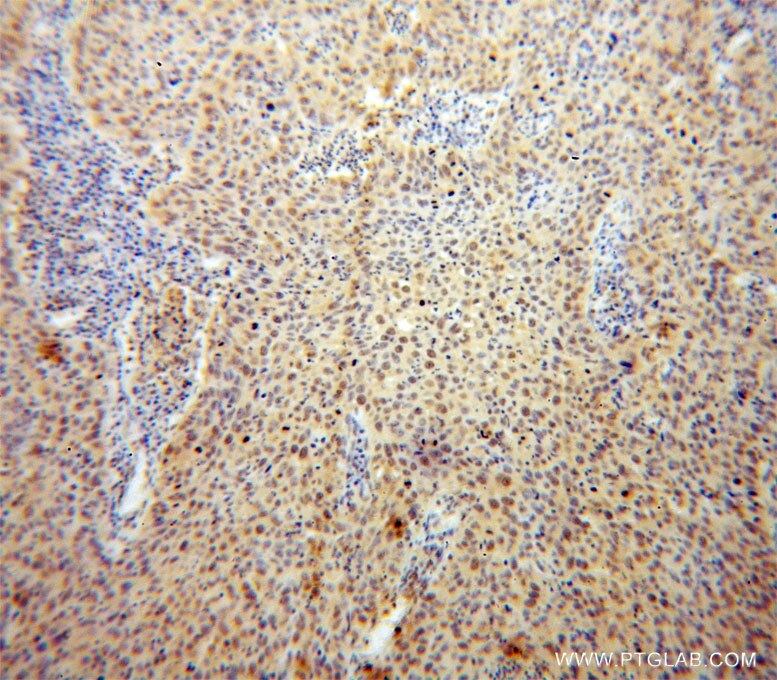 Immunohistochemistry (IHC) staining of human cervical cancer tissue using USP1 Polyclonal antibody (14346-1-AP)